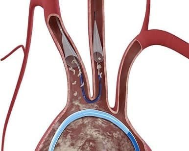 Importance of Embolic Protection Devices in Preventing Surgical Complications