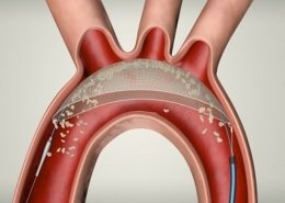 embolic protection devices market